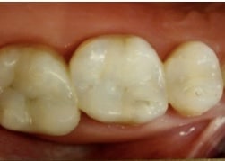 thumb_amalgum_after_picture-2_1024