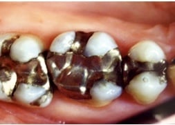 thumb_amalgum_before_picture_1024