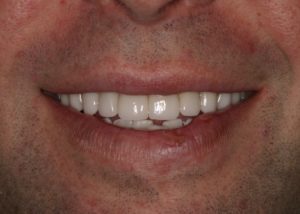 after veneers abington, pa