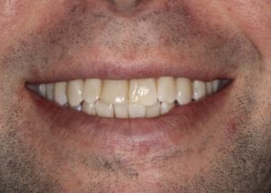 before veneers abington pa