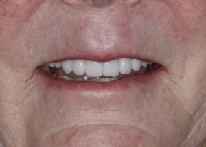 after dental crowns