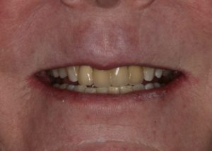 dental crown jenkintown pa