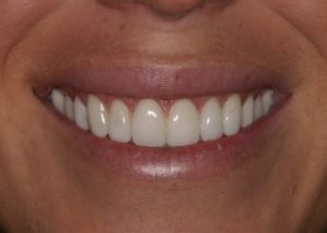 Neuromuscular treatment and veneers After 