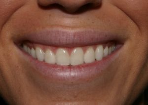 Nueromuscular and Veneers treatement before