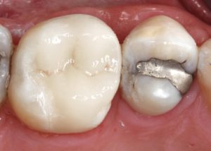 cerec dentist abington, pa