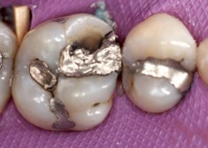 cerec dentist philadelphia