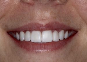 dental veneers jenkintown, pa