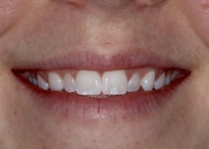 dental veneers abington, pa
