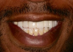Dental Bridges Philadelphia