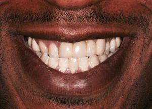 Dental Bridges Abington Pa