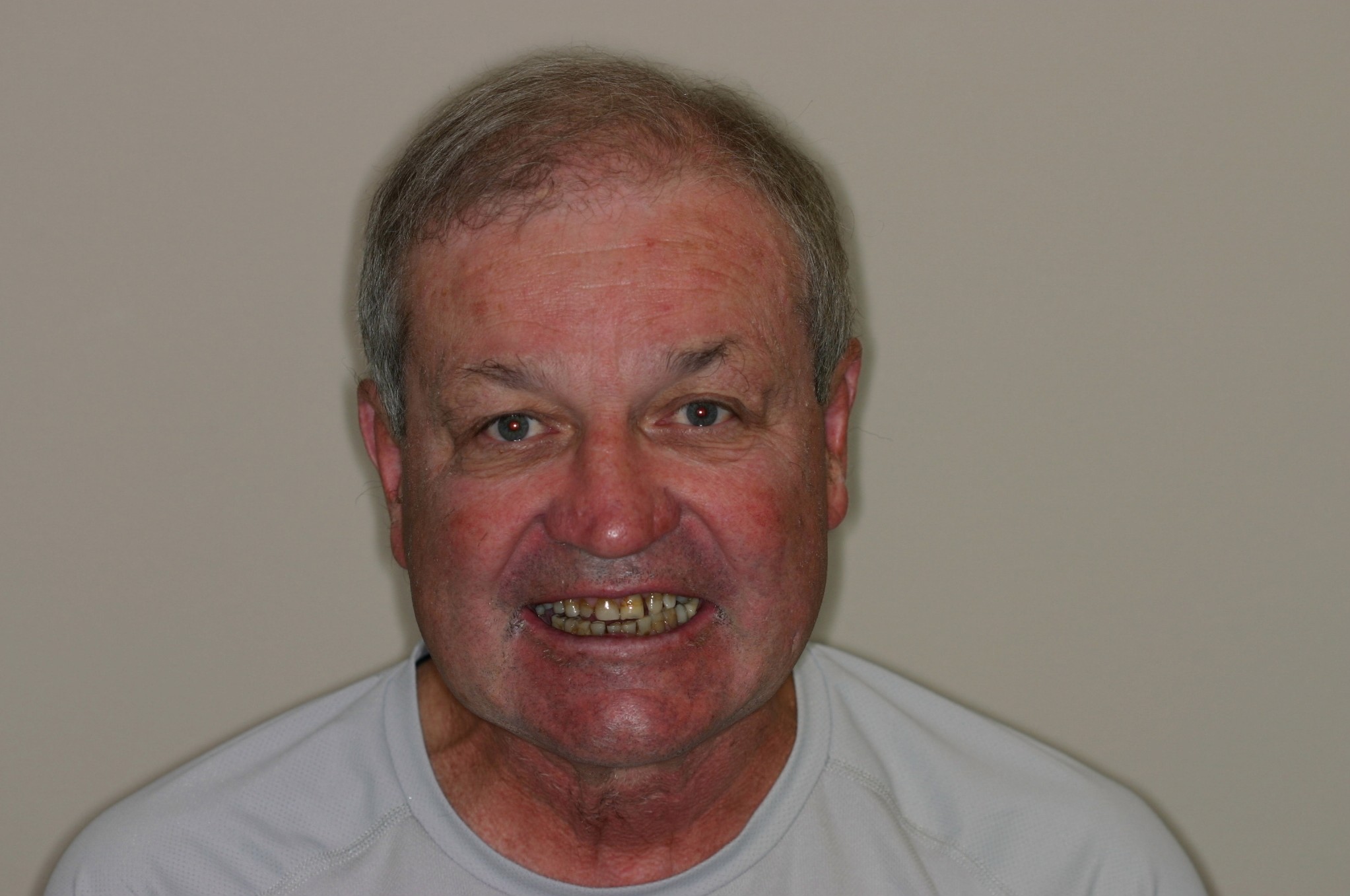 before dental crowns