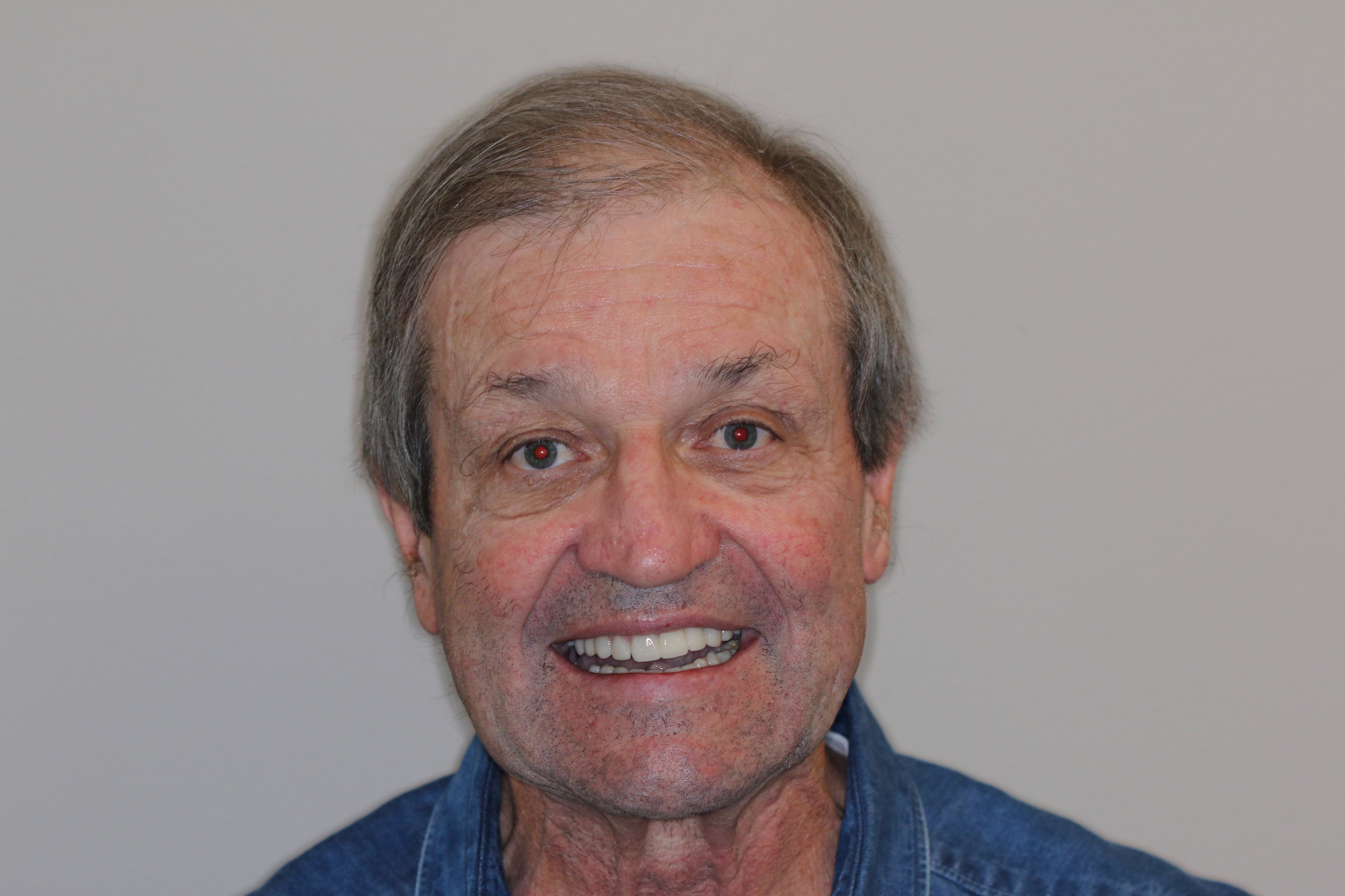 after dental crowns
