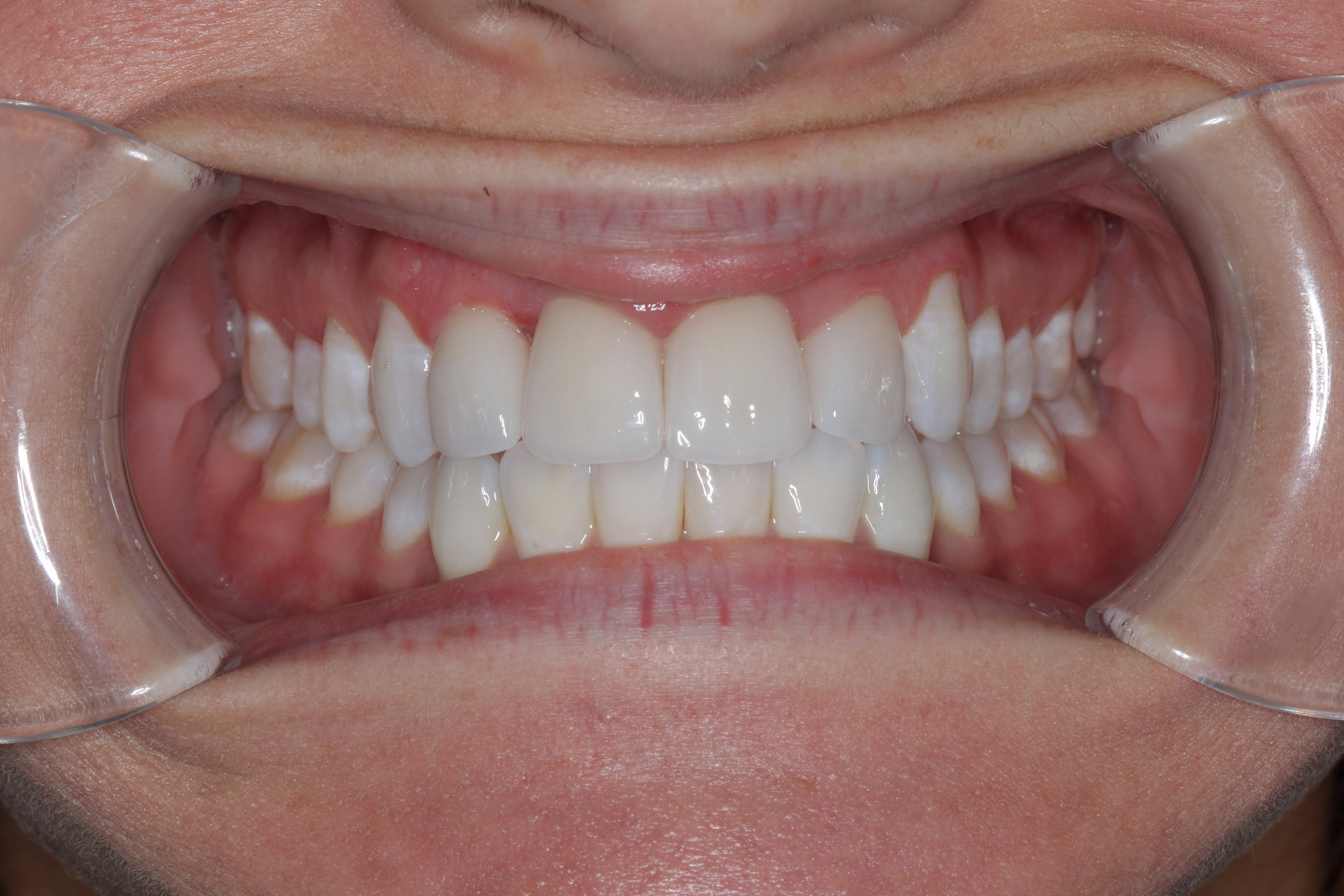 after neuromuscular dentistry abington pa