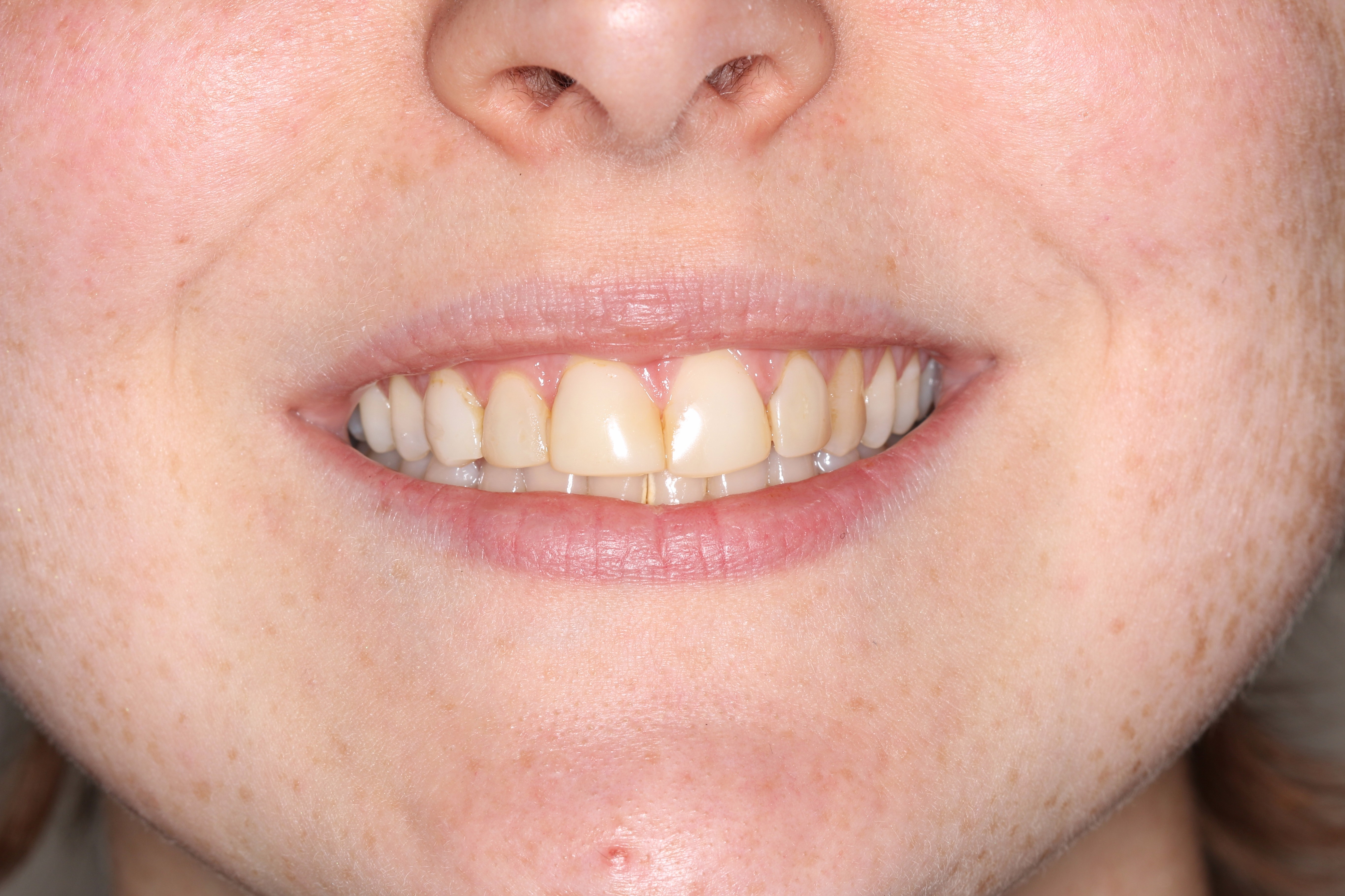 Teeth before Veneers