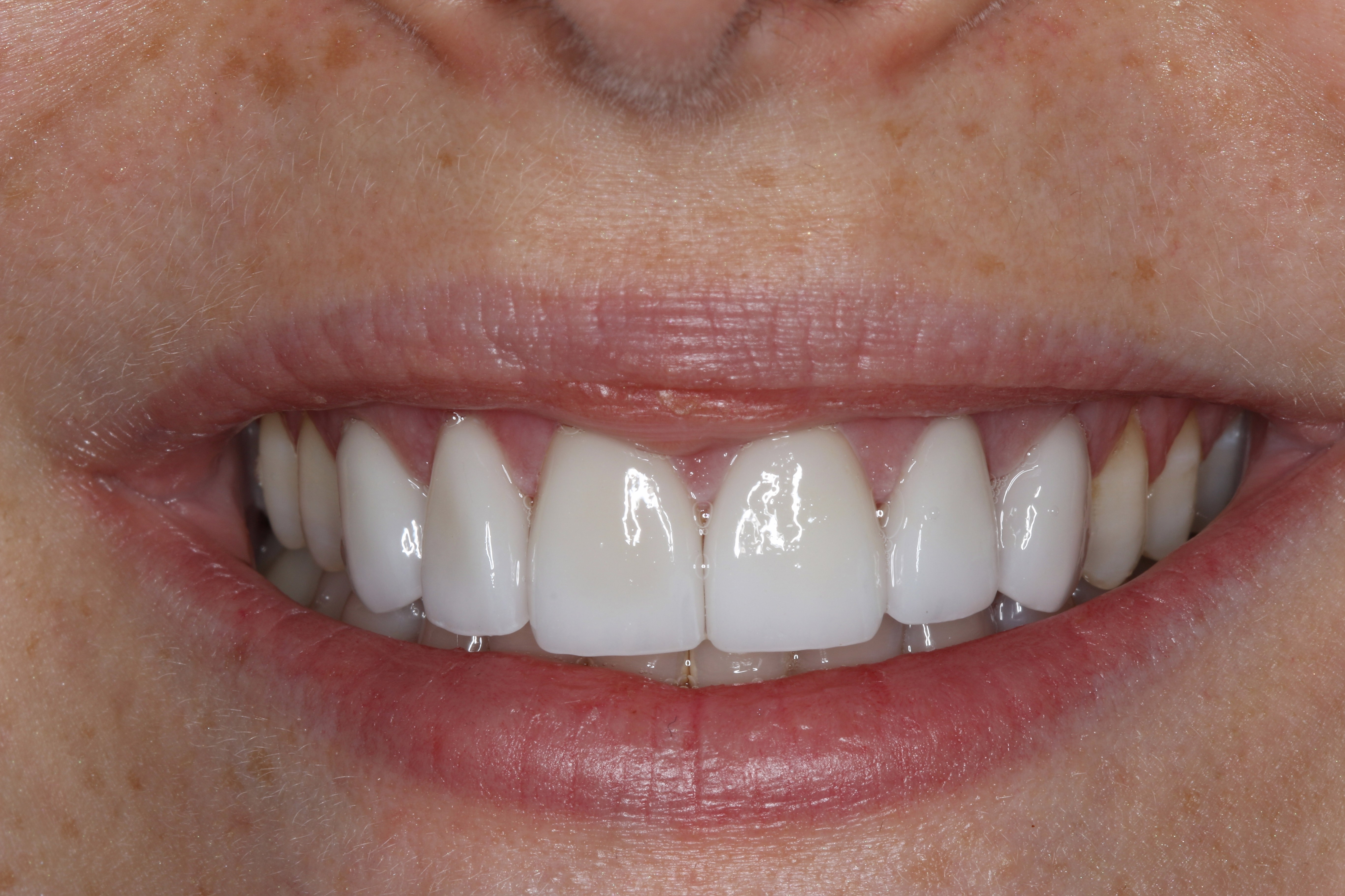 Teeth After Veneers