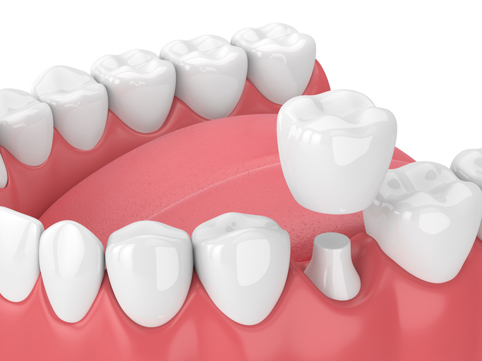 porcelain crowns abington pa