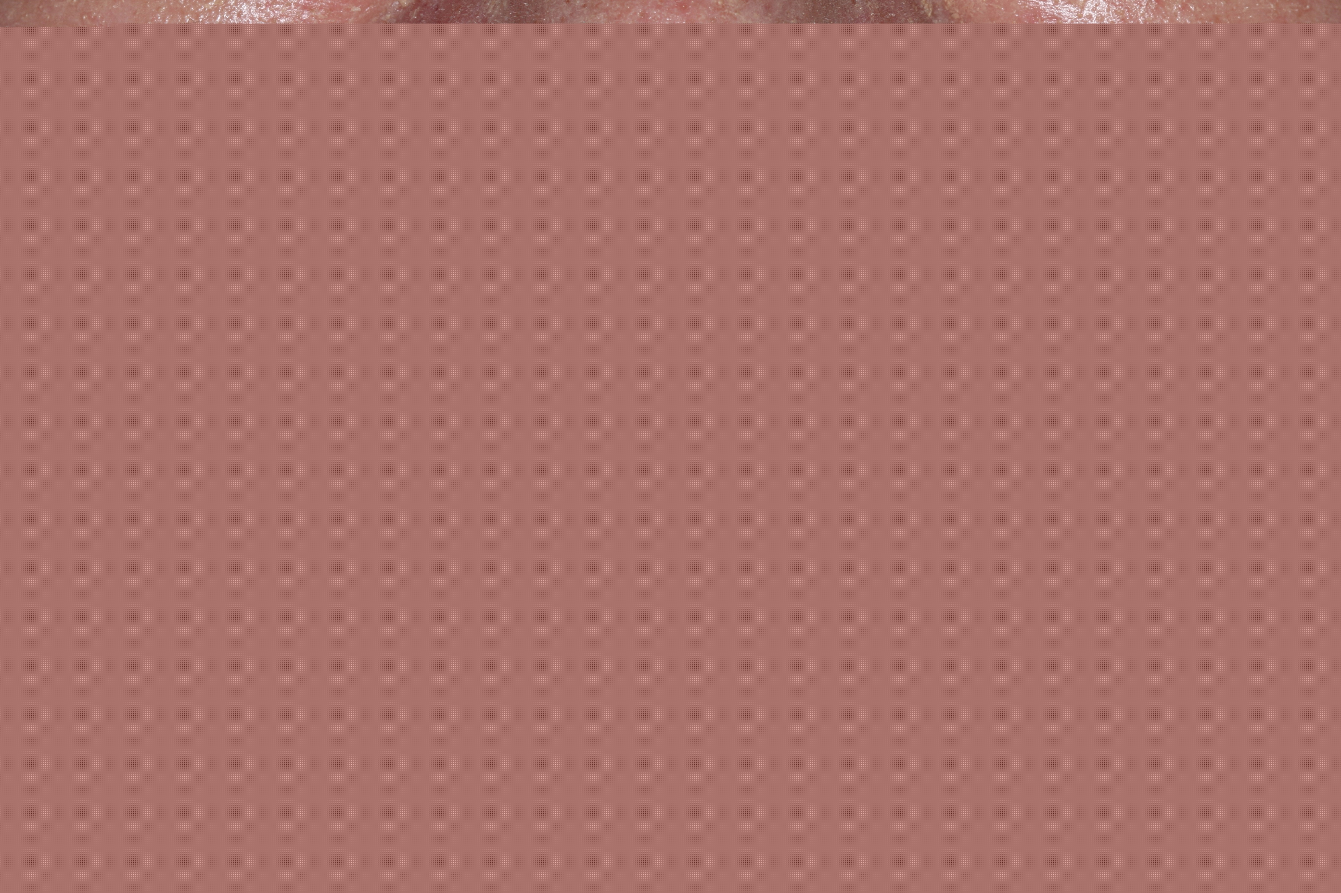 porcelain veneers abington PA