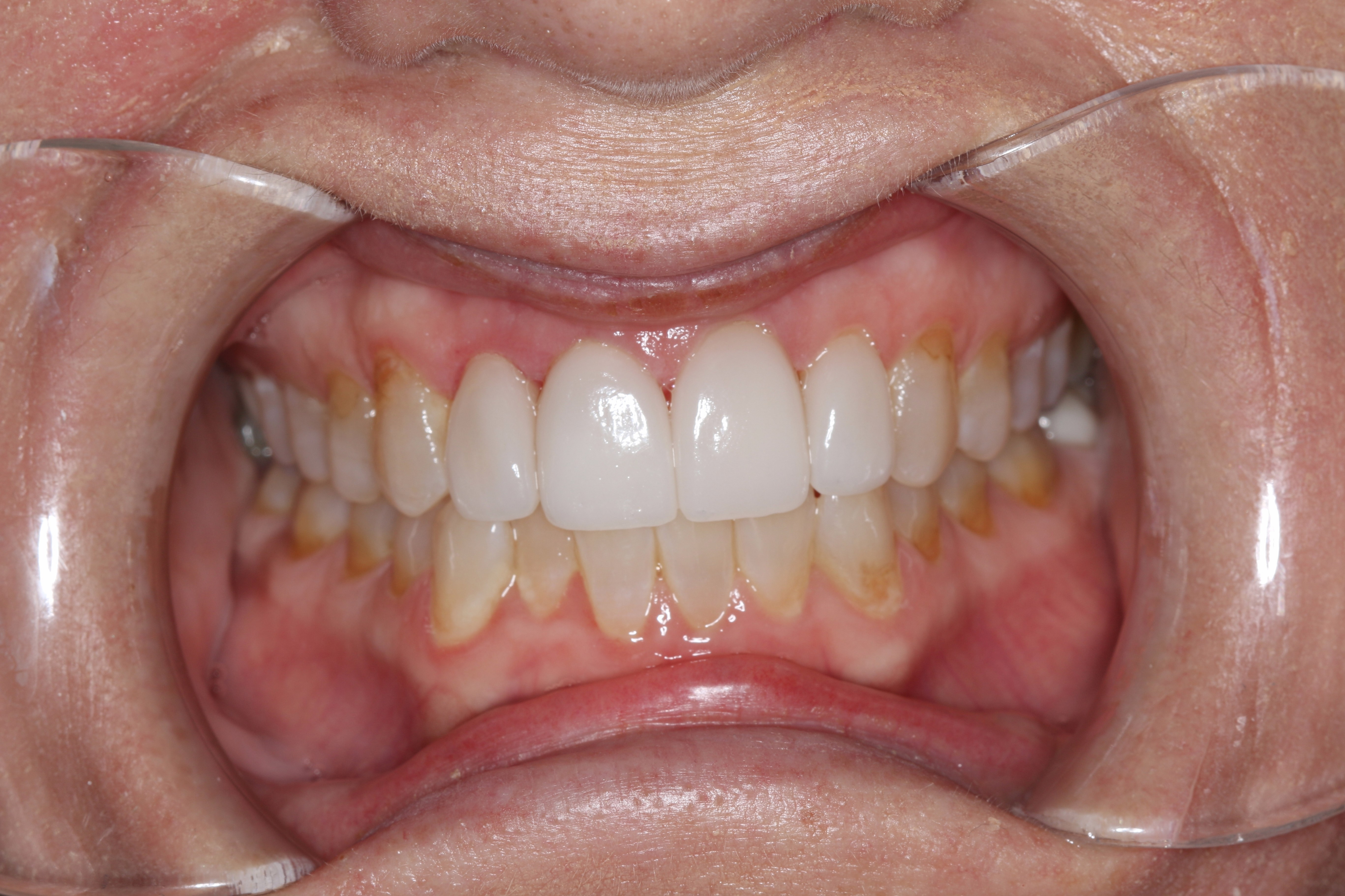 porcelain veneers abington PA