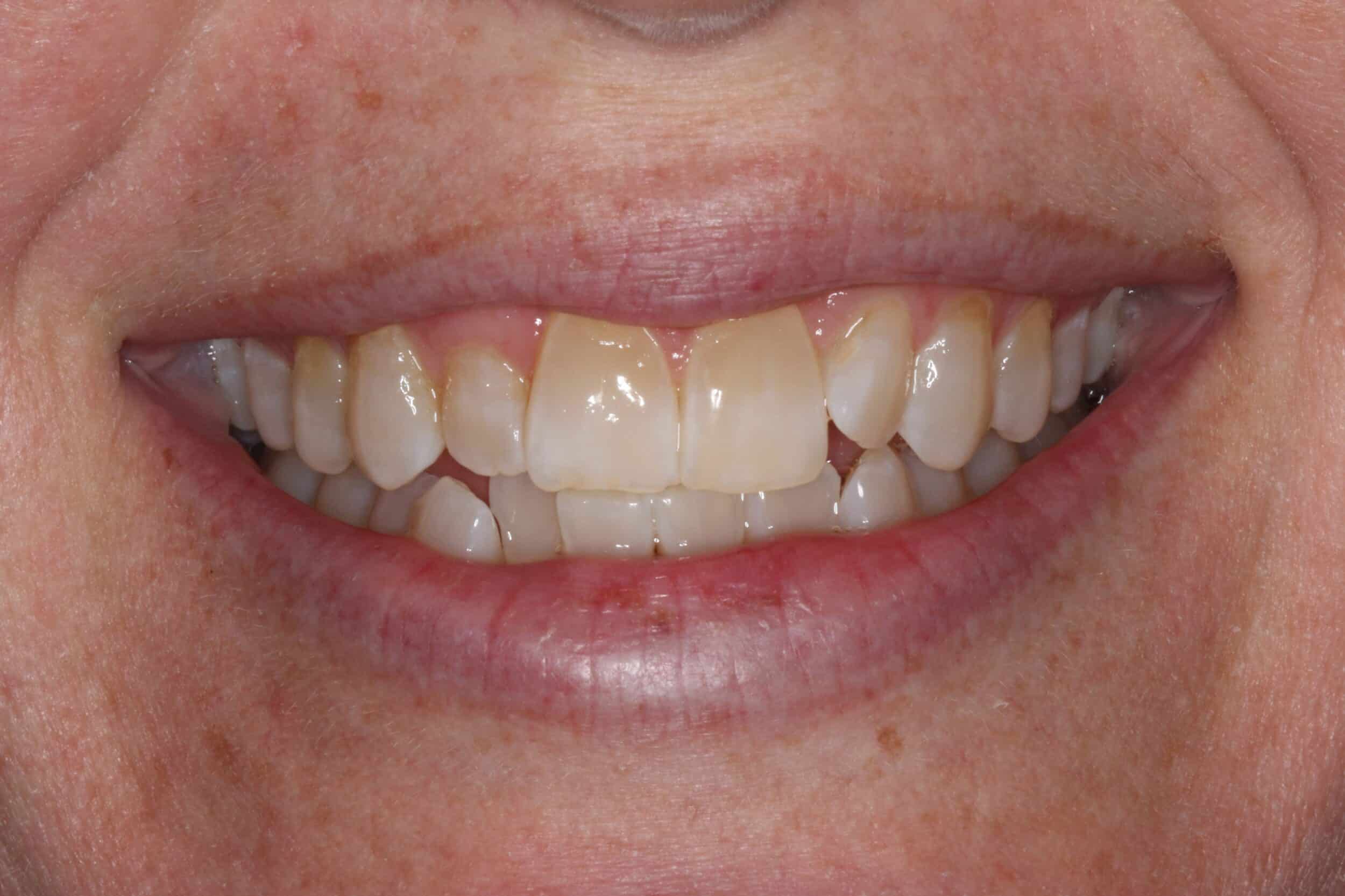 Before Smile Makeover Rydal PA