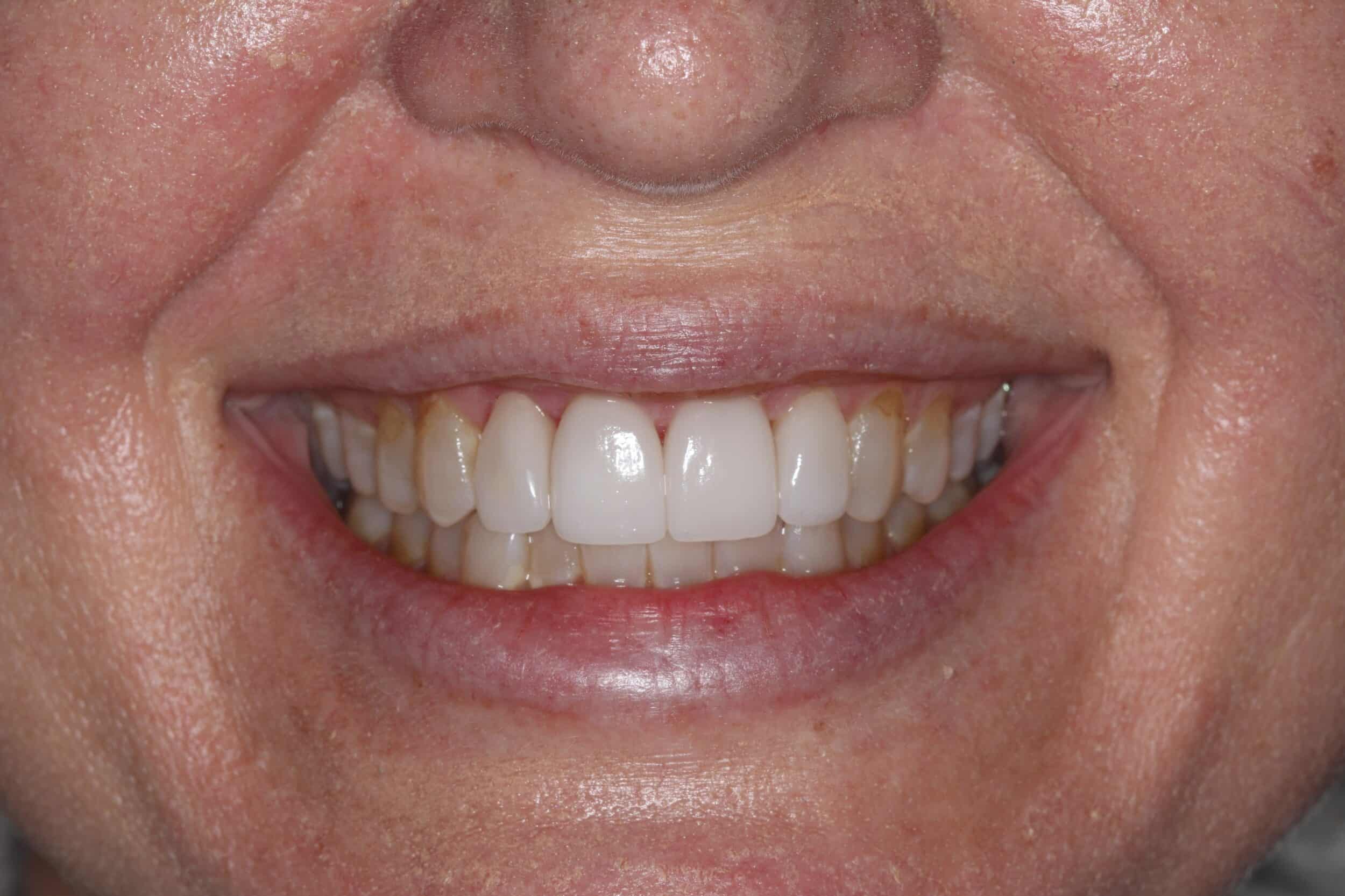 After Smile Makeover Rydal PA