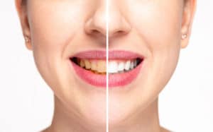 Smile Makeover Rydal PA