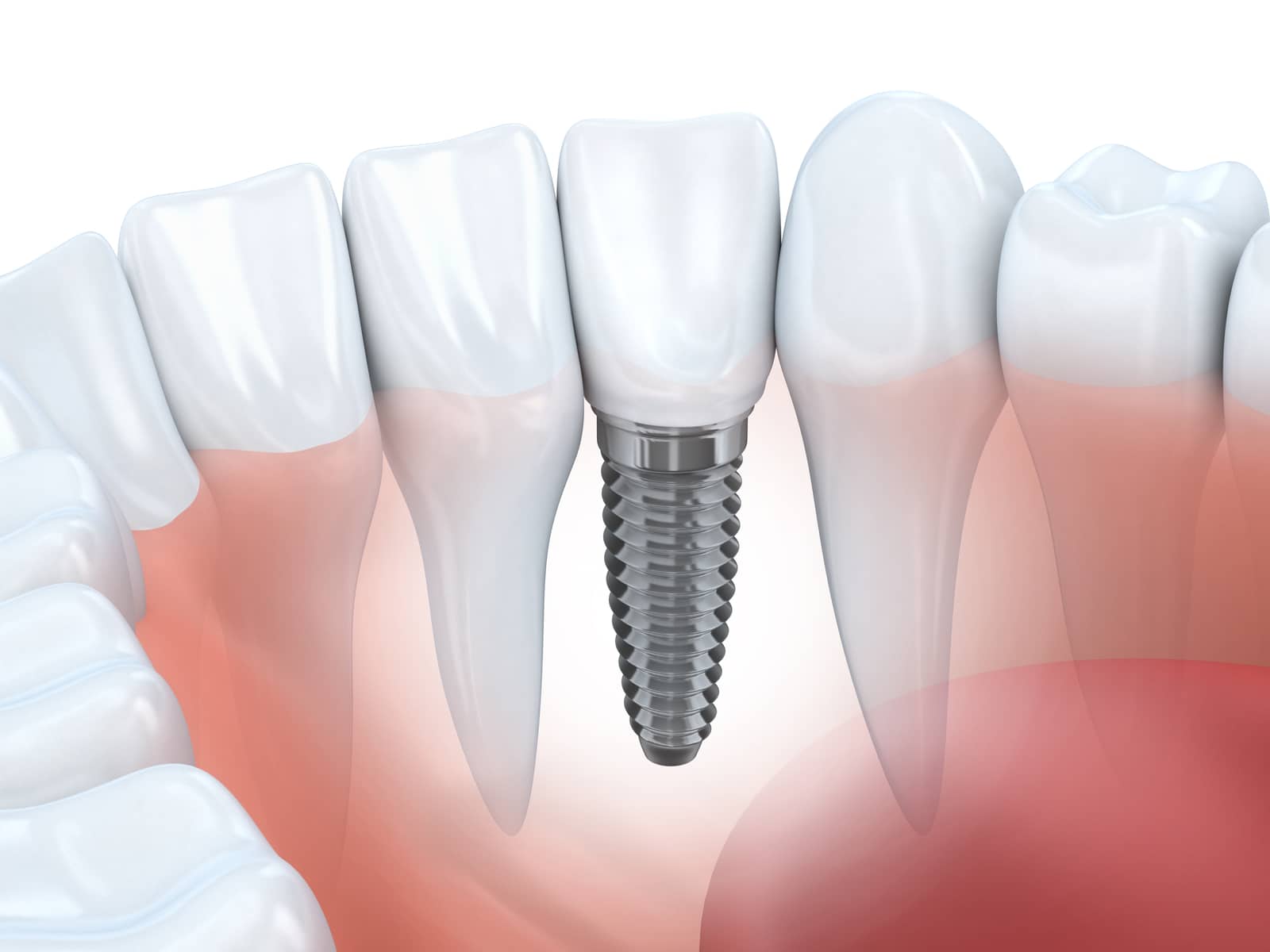 Dental implant