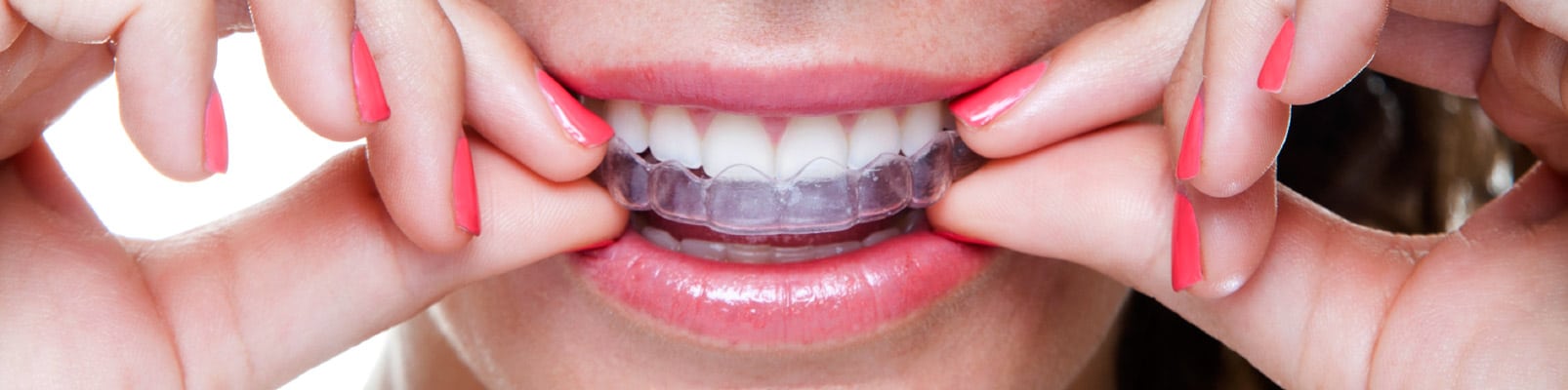 patient placing Invisalign clear aligner on upper teeth