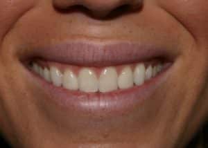 before TMJ Treatment Rydal PA