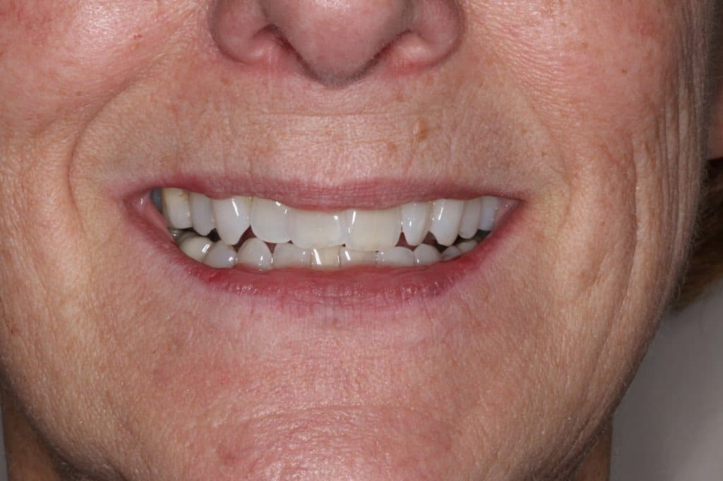 smiling patient’s teeth before invisalign