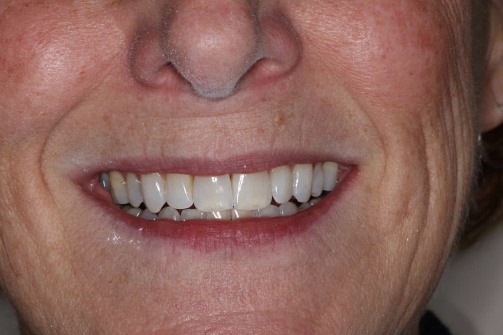 smiling patient’s teeth after invisalign, straighter after treatment