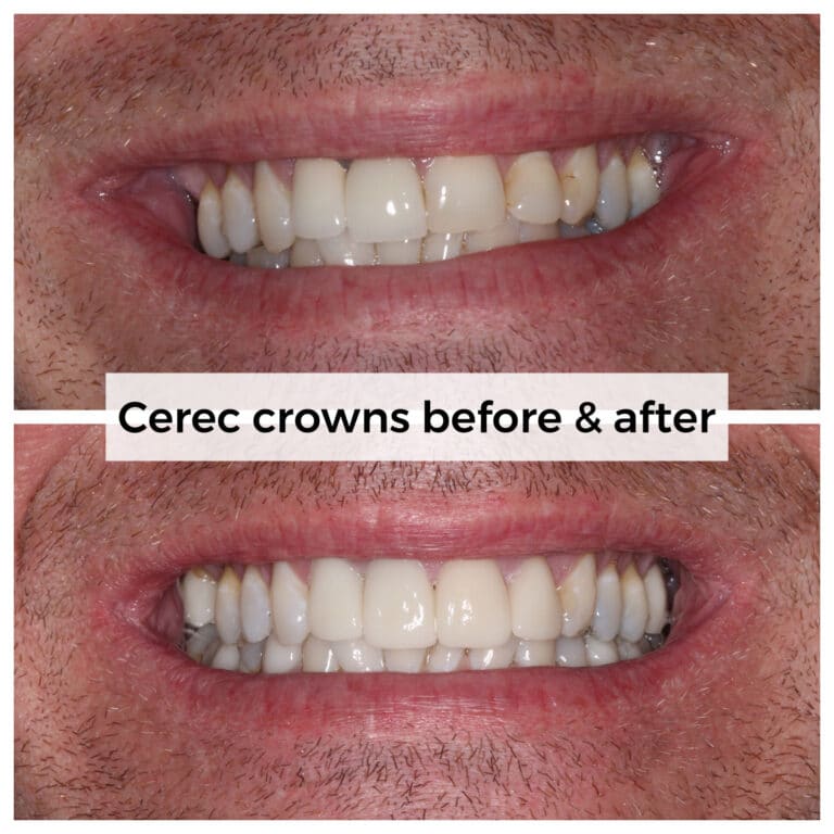 After Image: Cerec Crowns - front