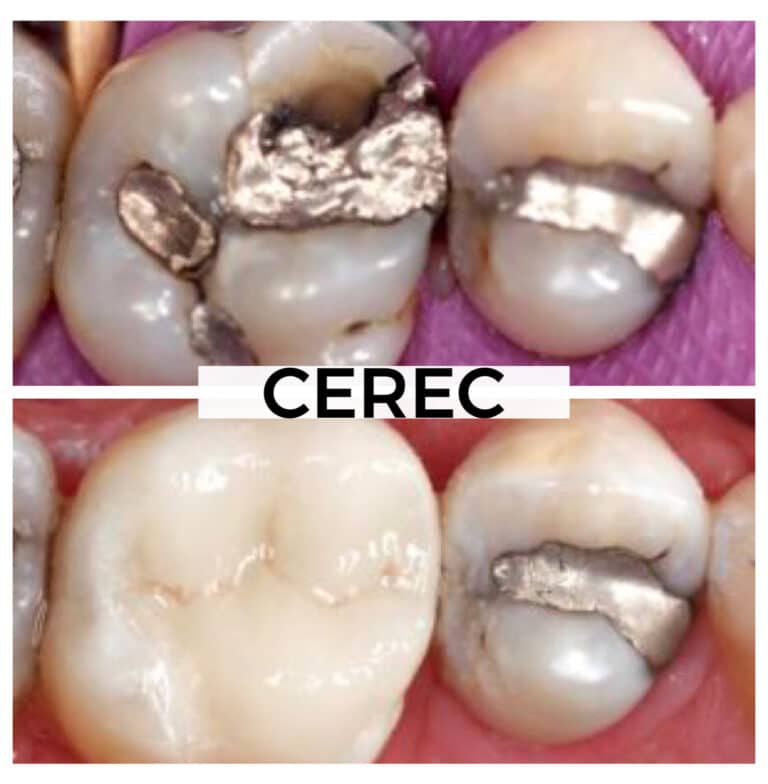 After Image: Cerec - front