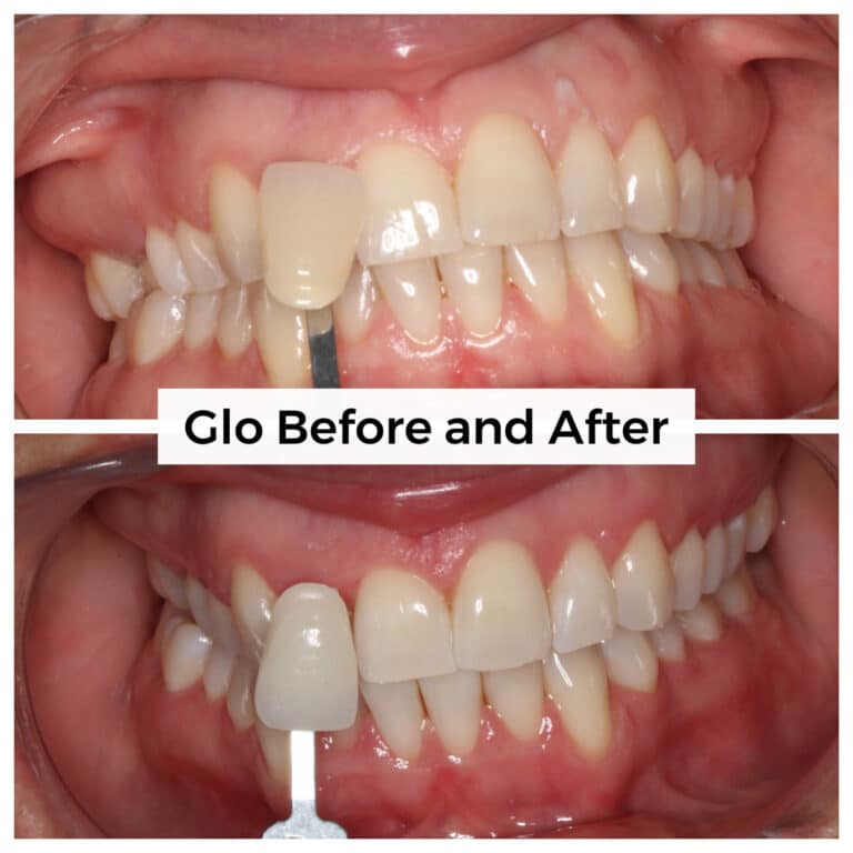 After Image: Glo - front