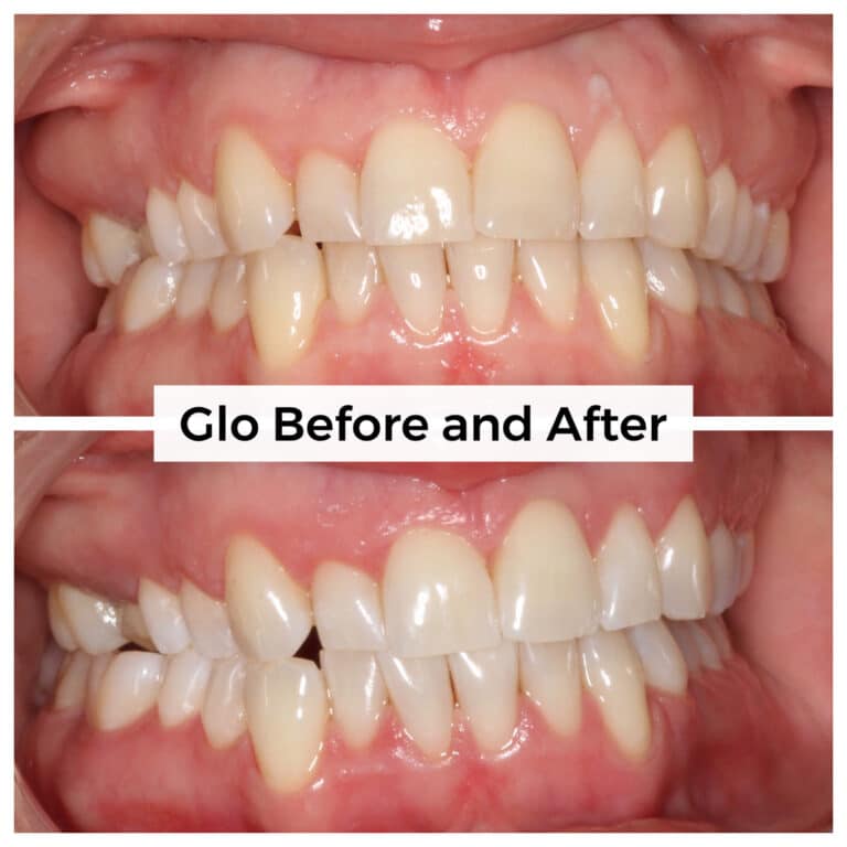 After Image: Glo - front
