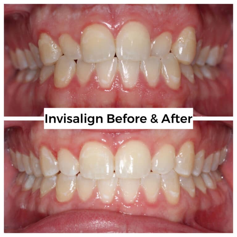 After Image: Invisalign - front