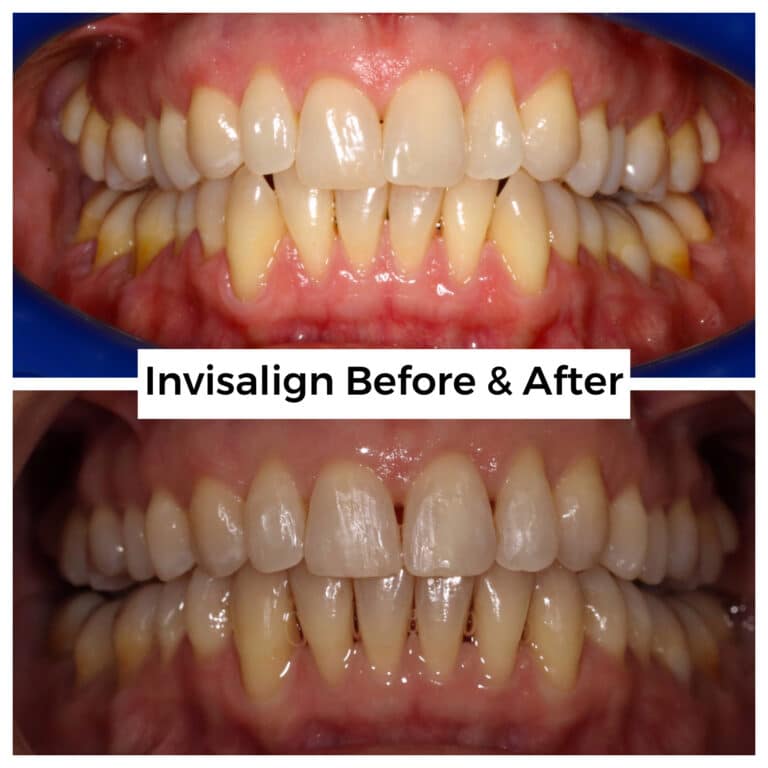After Image: Invisalign - front