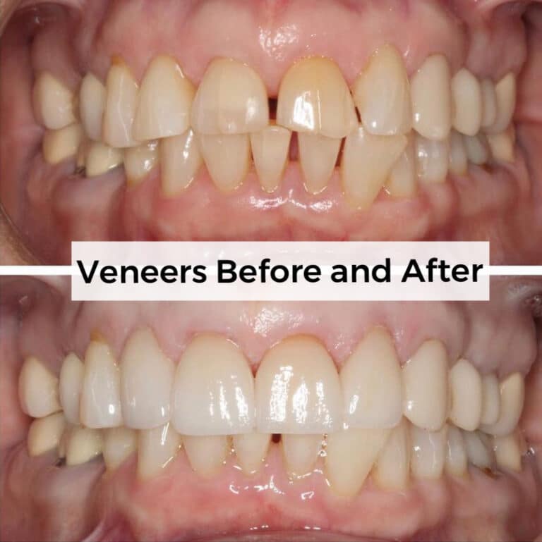 After Image: Veneers - front