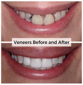 Veneers