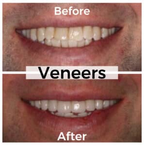 Veneers