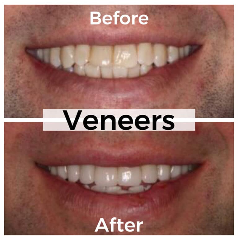 After Image: Veneers - front