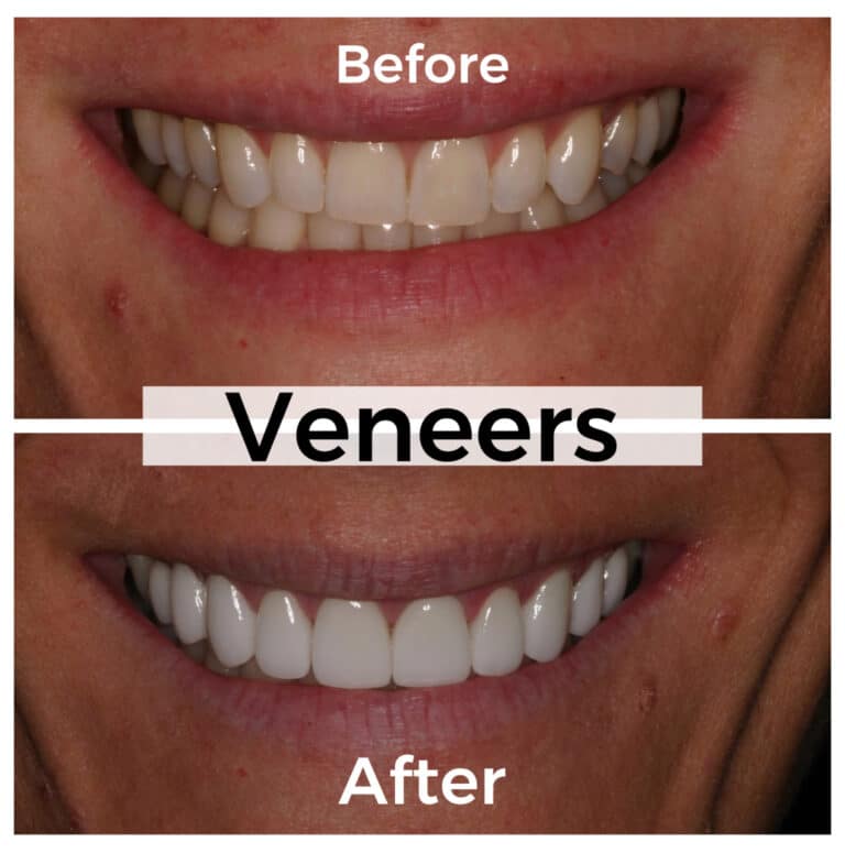 After Image: Veneers - front
