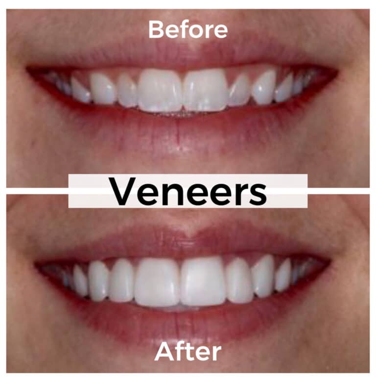 After Image: Veneers - front