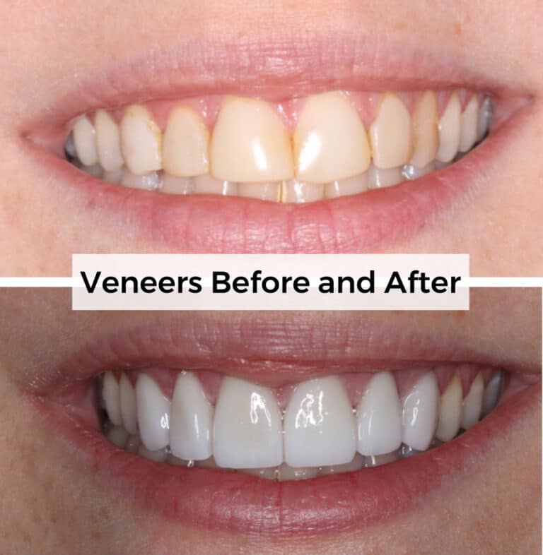 After Image: Veneers - front