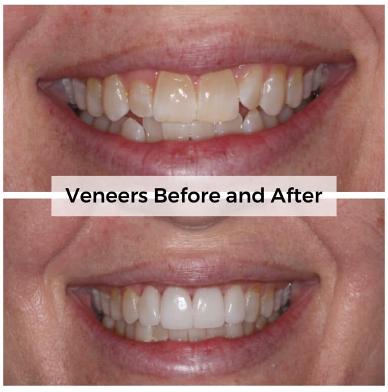 After Image: Veneers - front