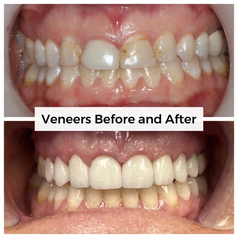 After Image: Veneers - front