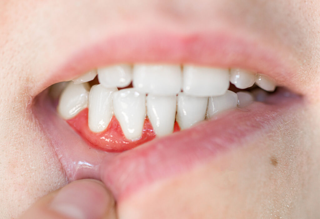 Close up,Of,Teeth.,Gum,Disease,In,A,Woman,,Periodontal,Disease.