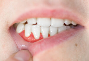 Close up,Of,Teeth.,Gum,Disease,In,A,Woman,,Periodontal,Disease.