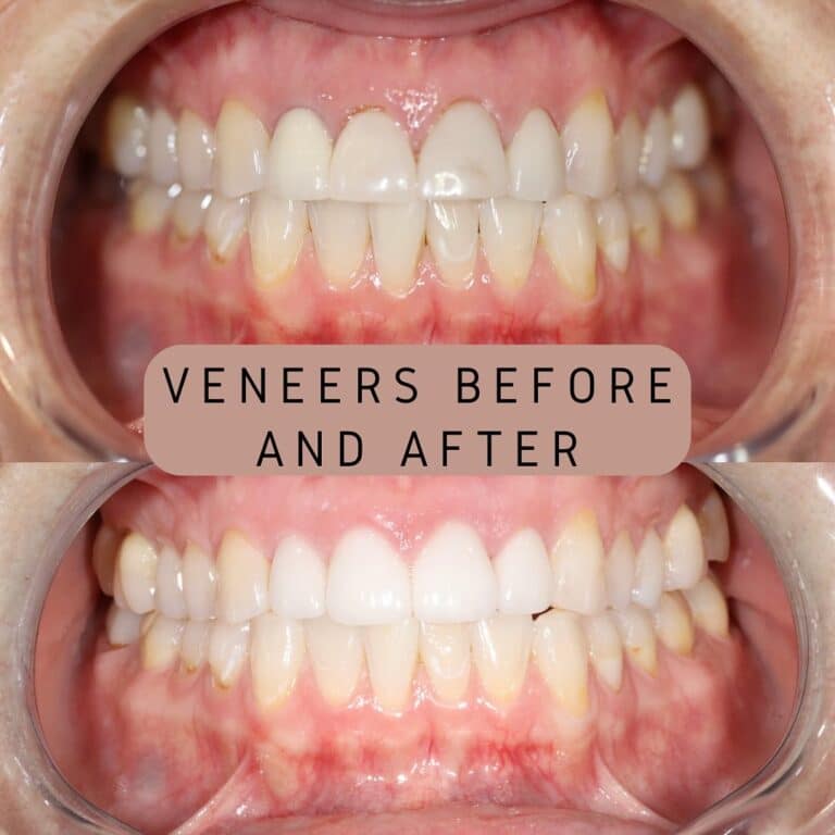 After Image: Veneers - front
